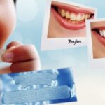 Are Whitening Strips Bad For Your Teeth?